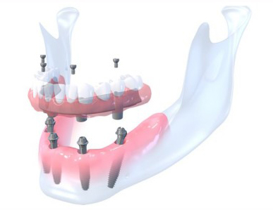 Diagram of a Pro Arch and dental implants being placed in the jaw